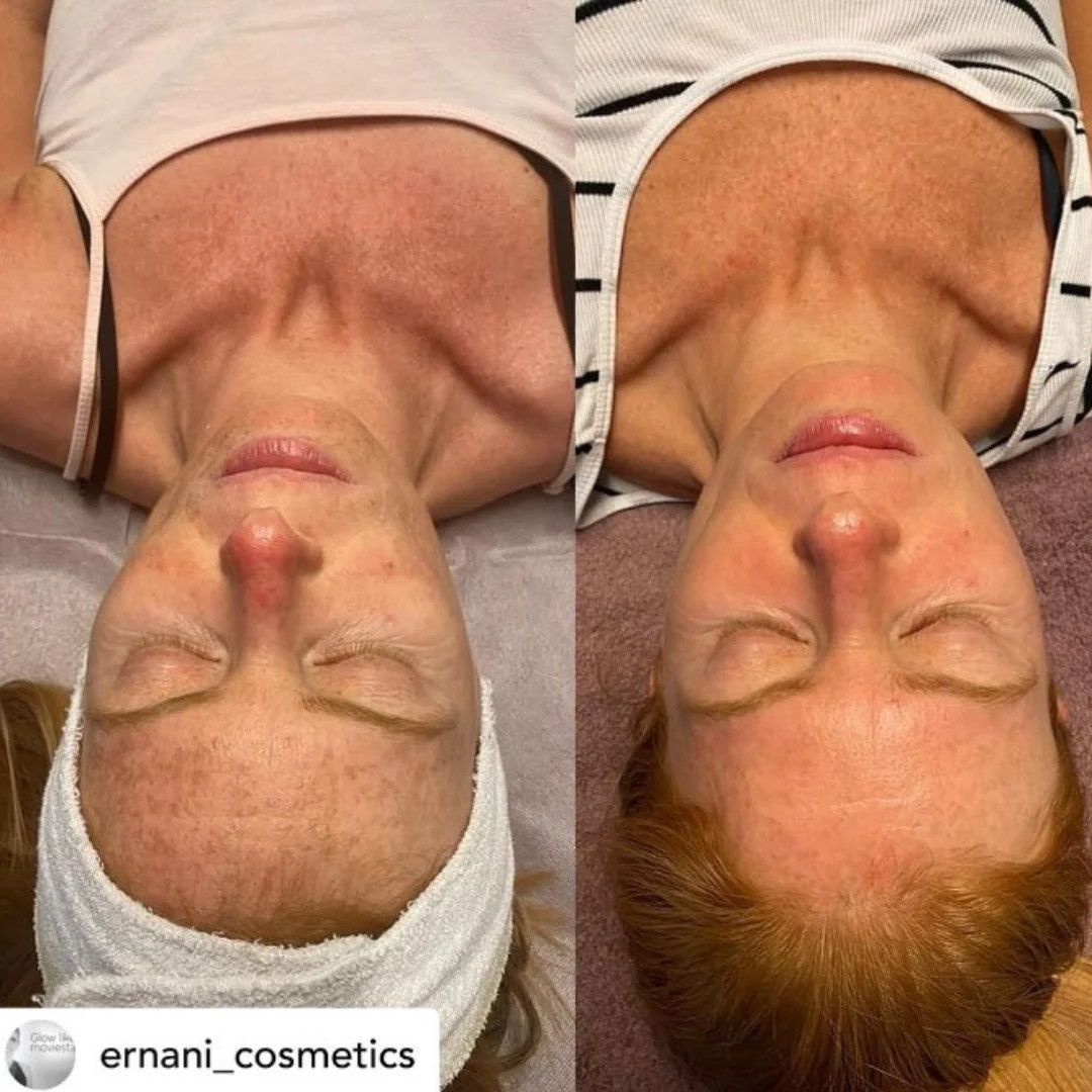 KRX Anti-aging ošetrenie